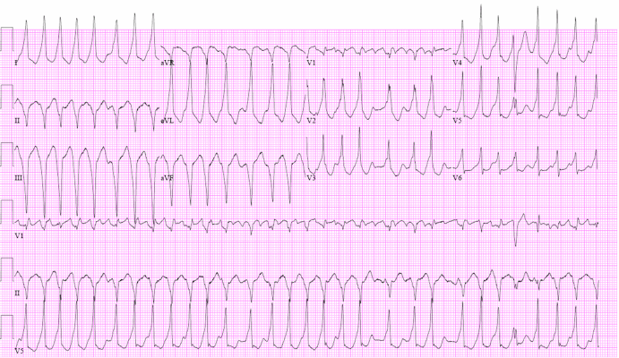 Cuồng nhĩ - Hình ảnh minh họa
